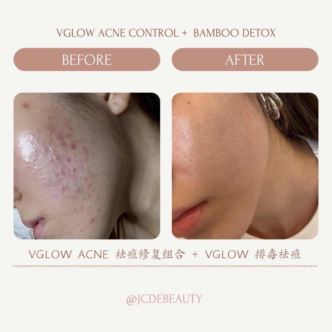 Before and after acne care result