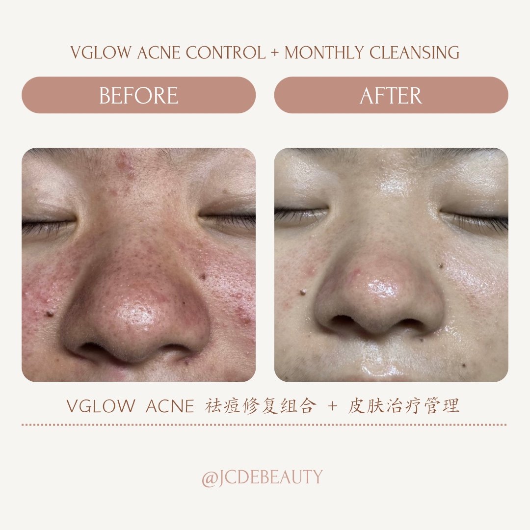 Before and after cleansing result