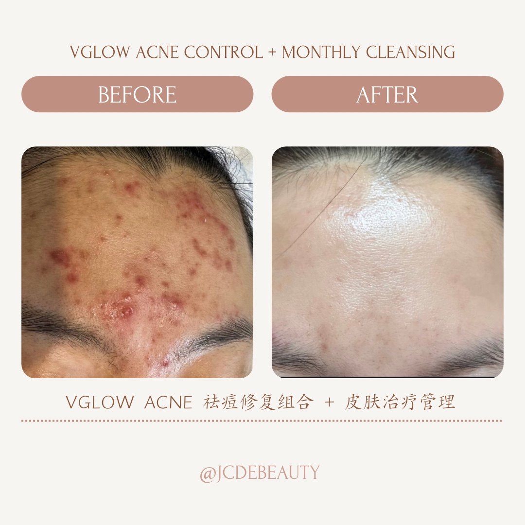 Before and after skin care result